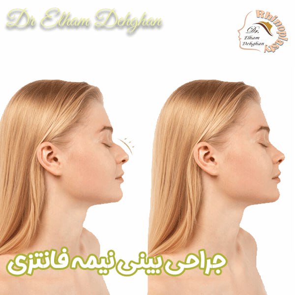 جراحی بینی نیمه فانتزی - دکتر الهام دهقان