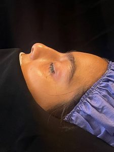 قبل از جراحی بینی استخوانی در کرمان _ دکتر الهام دهقان