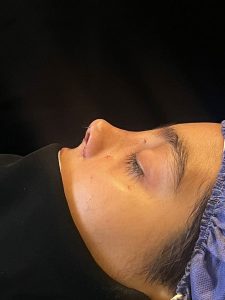 بعد از جراحی بینی استخوانی در کرمان _ دکتر الهام دهقان