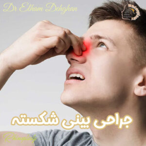 جراحی بینی شکسته - دکتر الهام دهقان