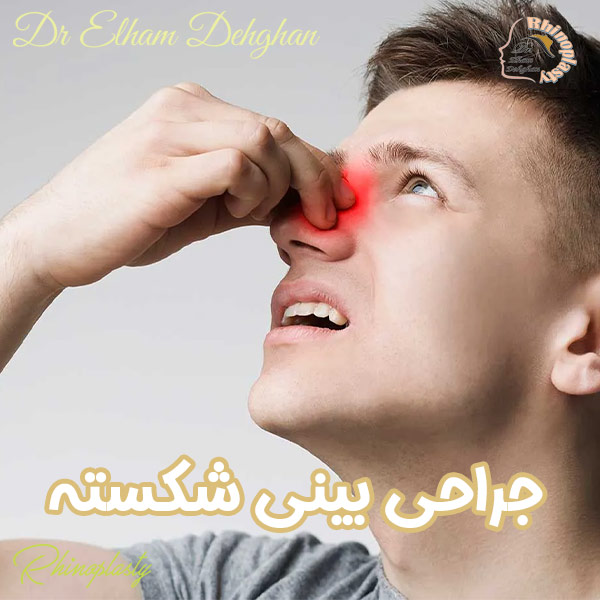جراحی بینی شکسته - دکتر الهام دهقان