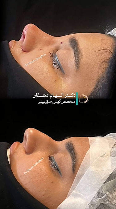 رینوپلاستی نچرال - دکتر الهام دهقان