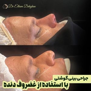 جراحی بینی گوشتی مردانه در کرمان _ دکتر الهام دهقان