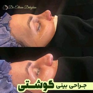 قبل و بعد عمل بینی گوشتی _ دکتر الهام دهقان