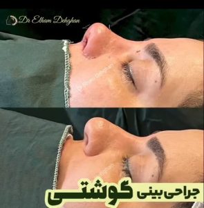 نمونه کار جراحی بینی نیمه فانتزی _ دکتر الهام دهقان