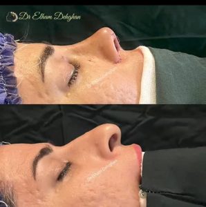 نمونه کار جراحی بینی نیمه عروسکی _ دکتر الهام دهقان