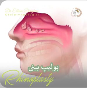 پولیپ بینی - دکتر الهام دهقان