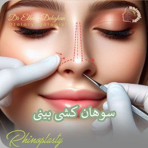 سوهان کشی بینی بعد از جراحی در کرمان - دکتر الهام دهقان