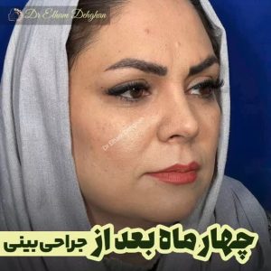 چهار ماه بعد از جراحی بینی در کرمان
