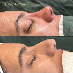 نتایج جراحی زیبای بینی در کرمان