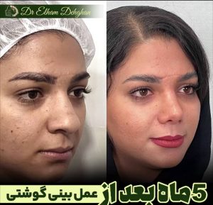 پنج ماه بعد از جراحی بینی گوشتی در کرمان