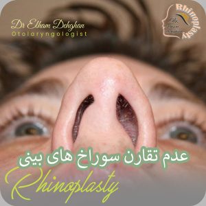 عدم تقارن سوراخ های بینی بعد از عمل - دکتر الهام دهقان