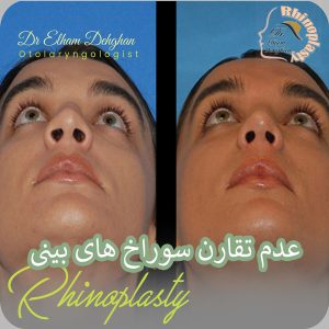 کوچک و بزرگ بودن بینی بعد از عمل - دکتر الهام دهفان