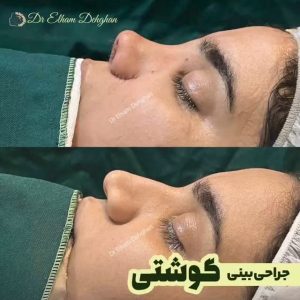 عکس نمونه کار جراحی بینی گوشتی از دکتر الهام دهقان 