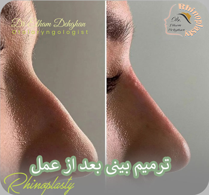 ترمیم بینی بعد از عمل 
