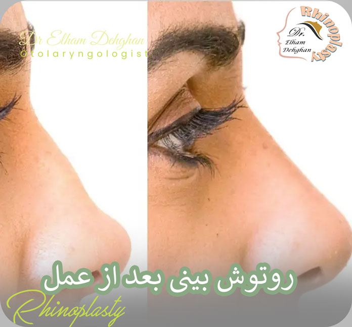 روتوش بینی بعد از عمل 