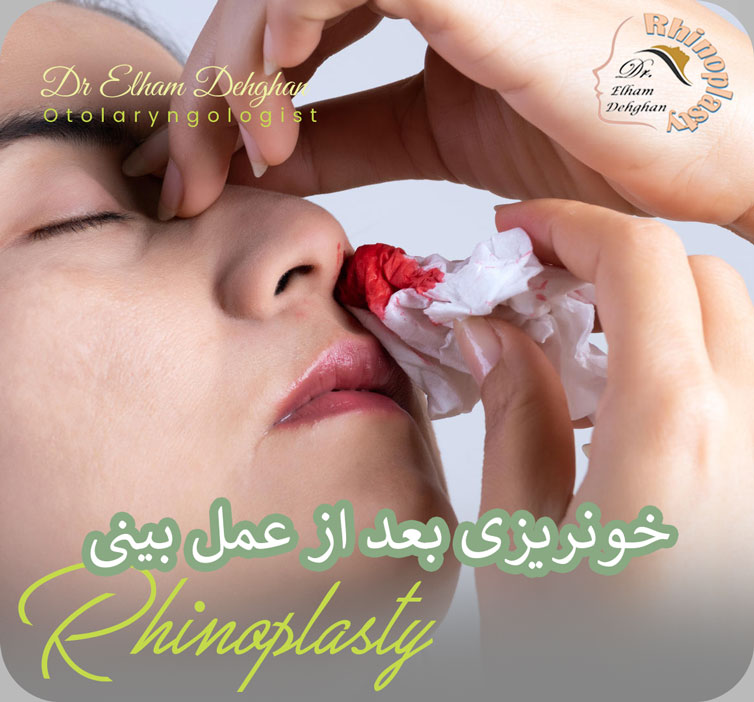 خونریزی بعد از عمل بینی 