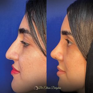 جراحی بینی در کرمان و عکس بعد از عمل