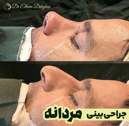 جراحی بینی 1