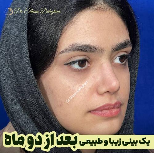 جراحی بینی 4