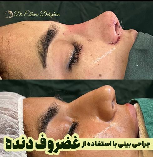 جراحی بینی 7