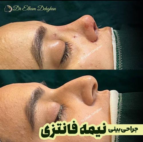 جراحی بینی 9