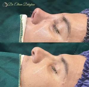 rhinoplasty-12