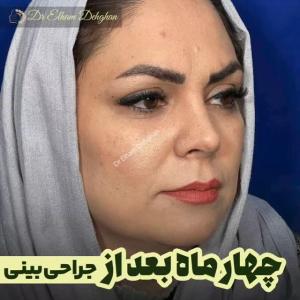 rhinoplasty-13