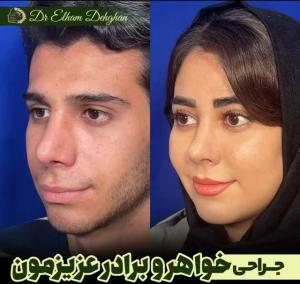 rhinoplasty-14