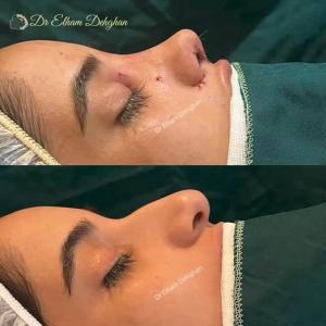 rhinoplasty-16