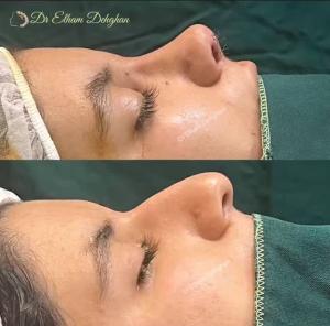 rhinoplasty-17