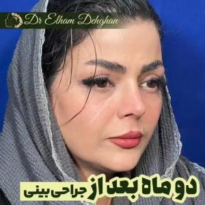 rhinoplasty-18