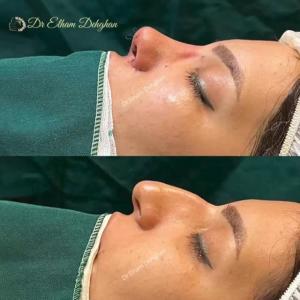 rhinoplasty-19