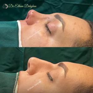 rhinoplasty-20
