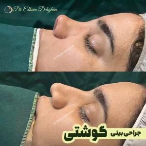 rhinoplasty-21