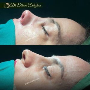 rhinoplasty-22