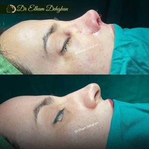 rhinoplasty-23