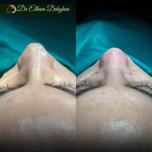 rhinoplasty-24