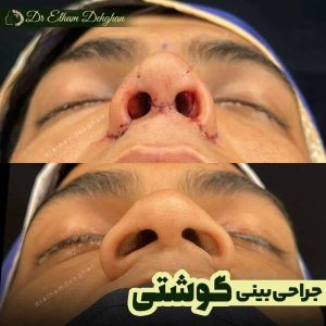 rhinoplasty-25