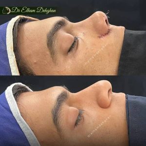 rhinoplasty-26