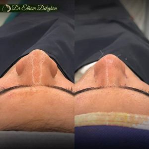 rhinoplasty-27