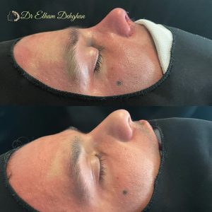 rhinoplasty-28