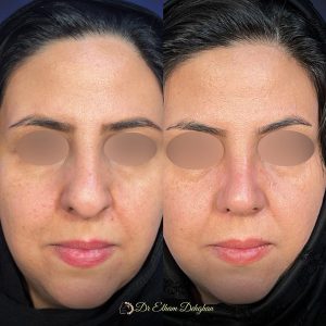 rhinoplasty-29
