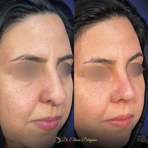 rhinoplasty-30