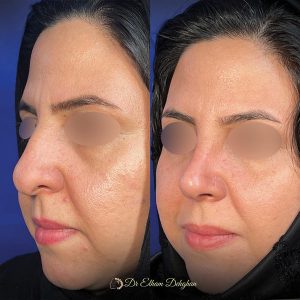 rhinoplasty-31