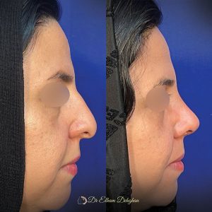rhinoplasty-32
