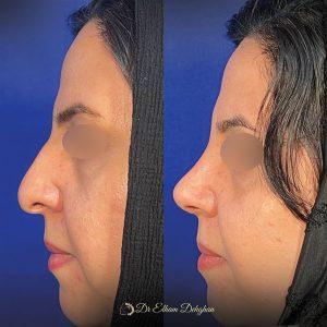 rhinoplasty-33