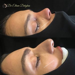 rhinoplasty-34