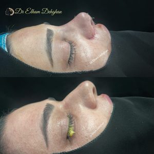 rhinoplasty-35