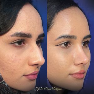 rhinoplasty-37